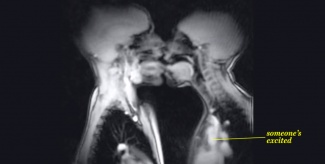 Suudelma MRI-kuvassa